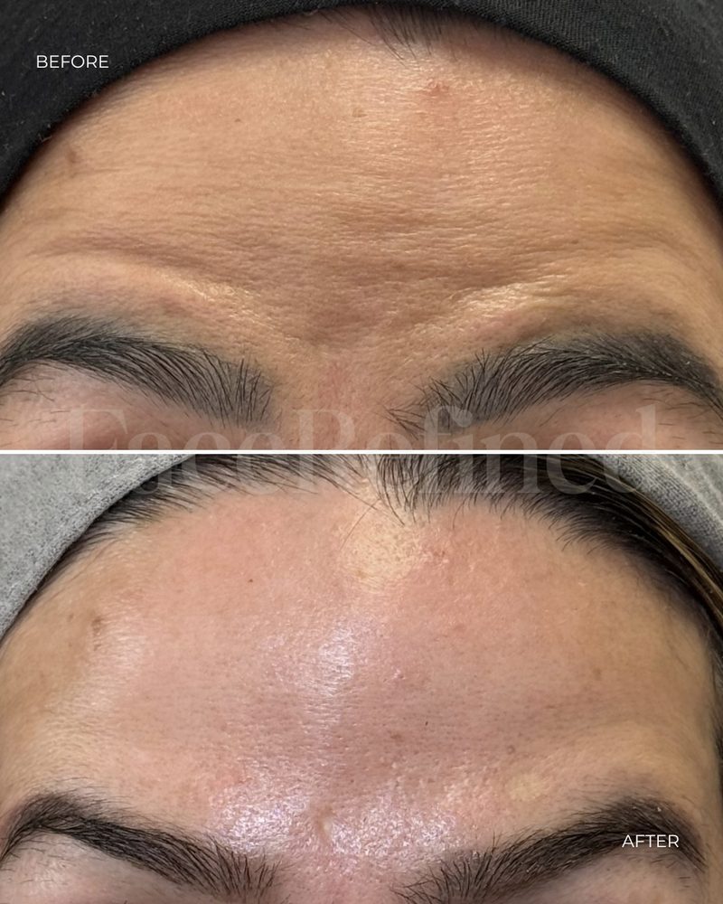 Before and after forehead anti-wrinkle treatment