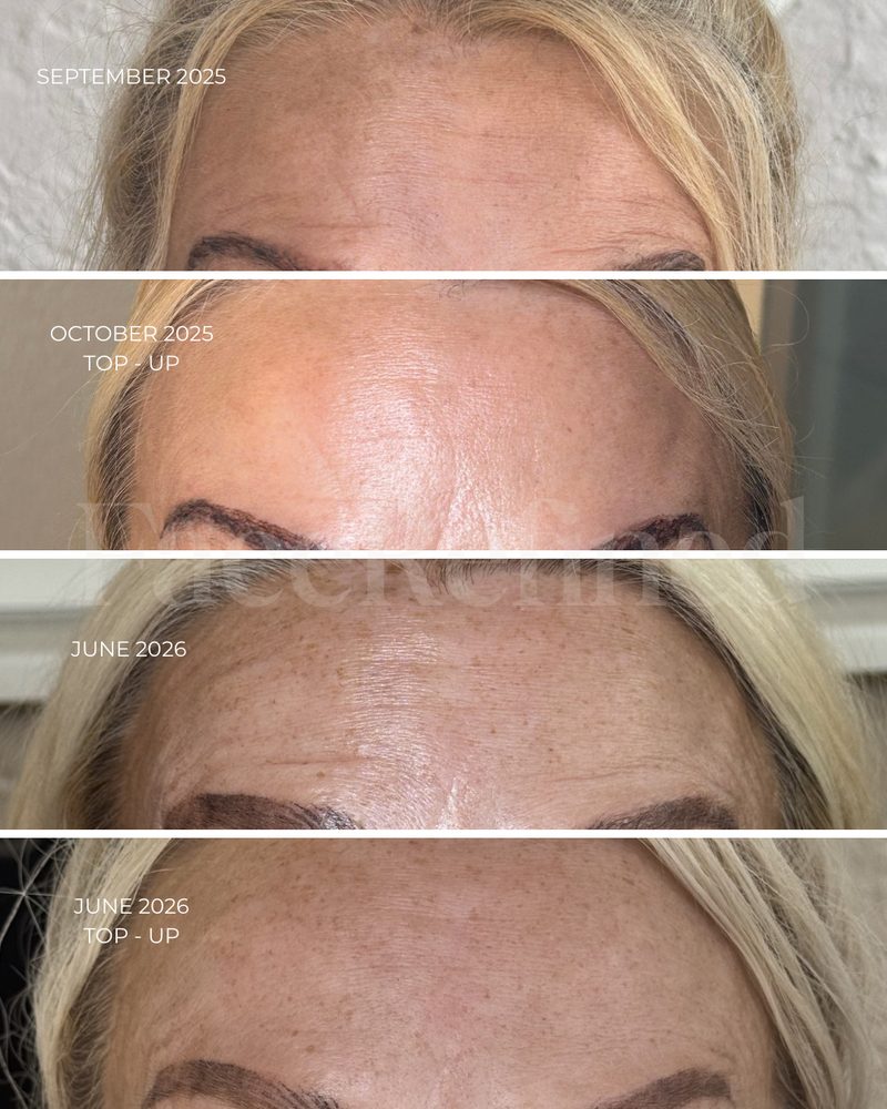 Forehead anti-wrinkle results over time, September 2025 to June 2026