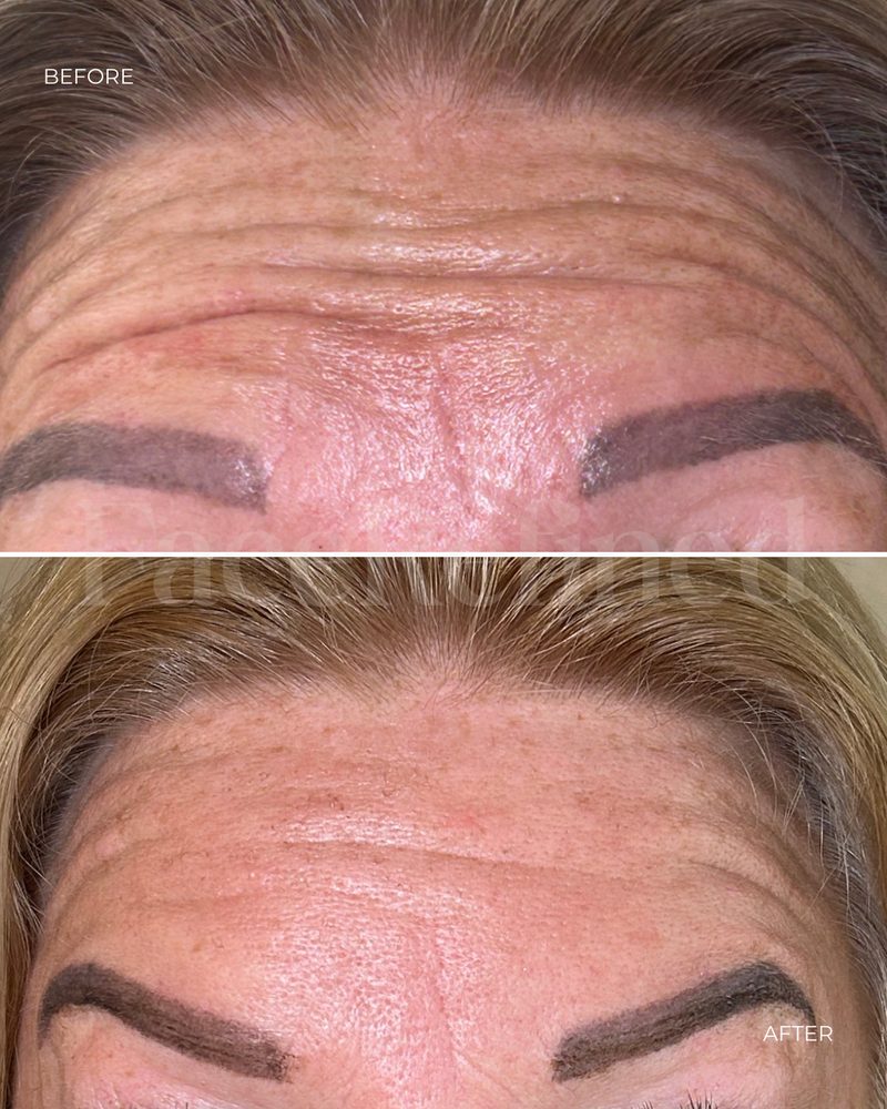 Before and after forehead anti-wrinkle treatment, third example