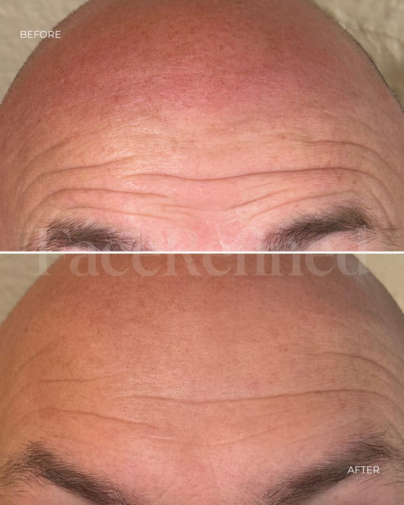 Before and after forehead anti-wrinkle treatment, fourth example