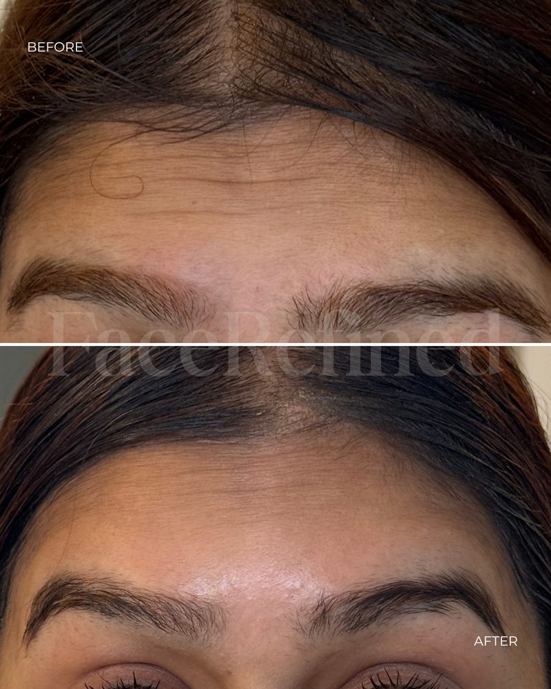 Before and after forehead and brow lift anti-wrinkle treatment