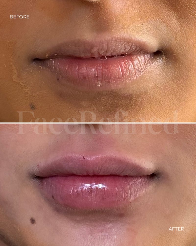 Before and after lip treatment