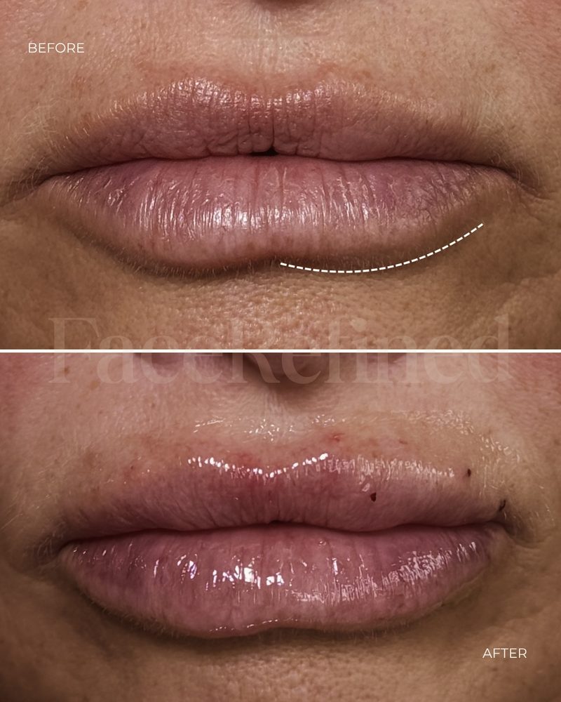 Before and after lip treatment, second example
