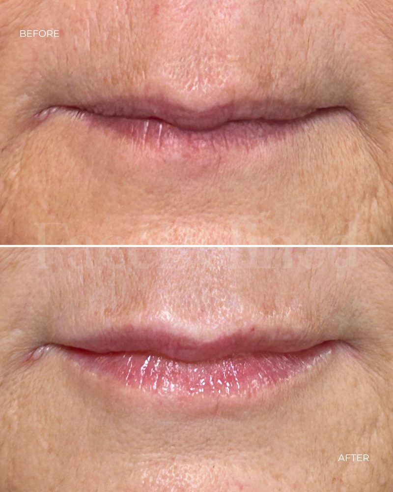 Before and after lip treatment, third example