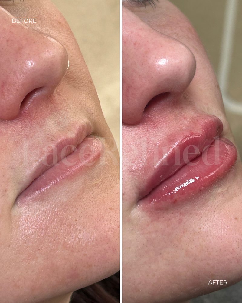 Before and after lip treatment, fourth example