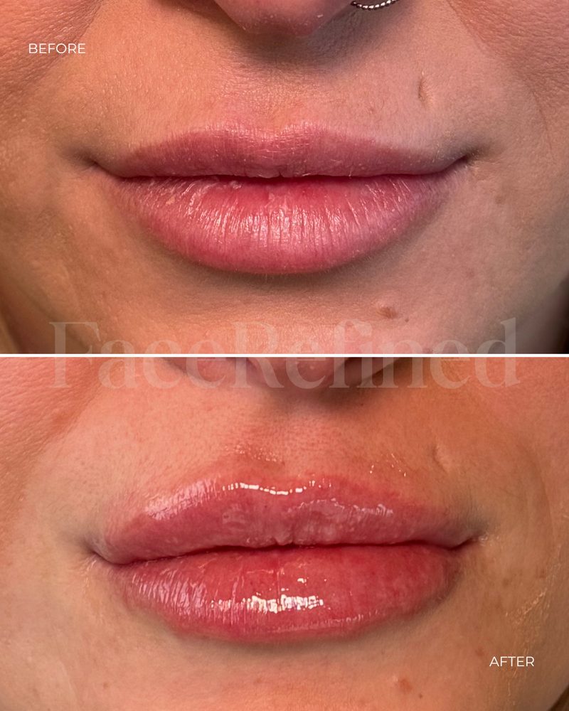 Before and after lip treatment, fifth example