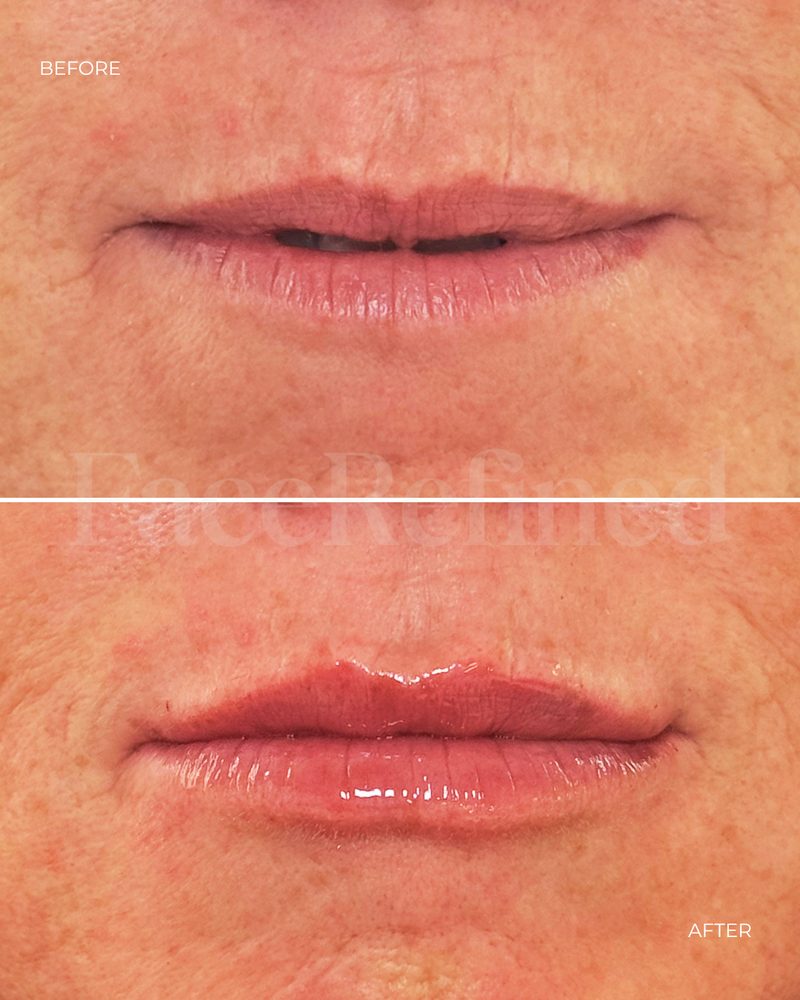 Before and after lip treatment, sixth example